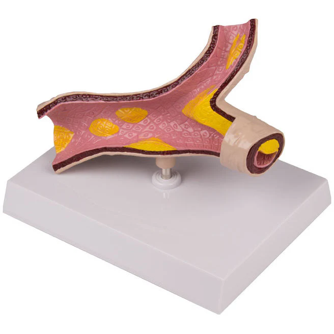 Arteriosclerosis Model - 1-Part