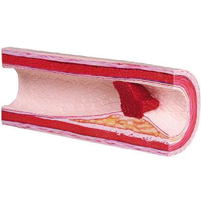 Atherothrombosis Model with Removable Thrombus