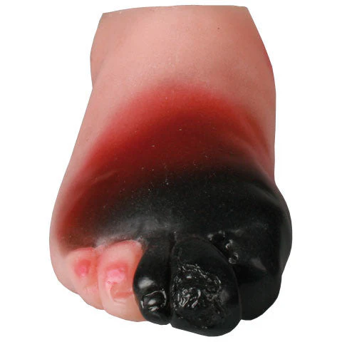 Diabetic Foot Model - Severe Stage