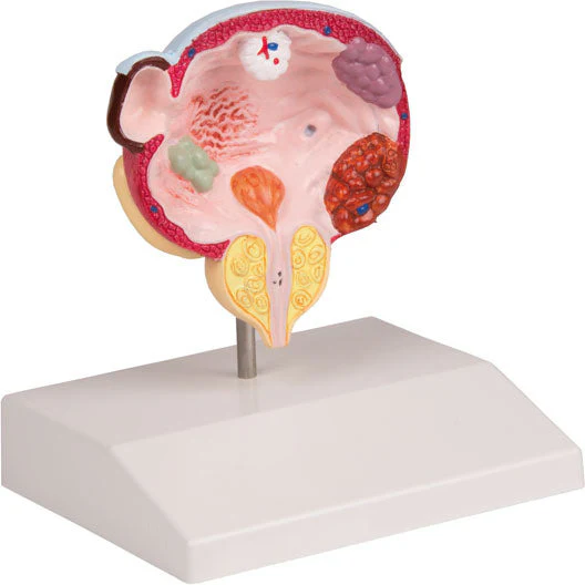 Diseases of Bladder & Prostate