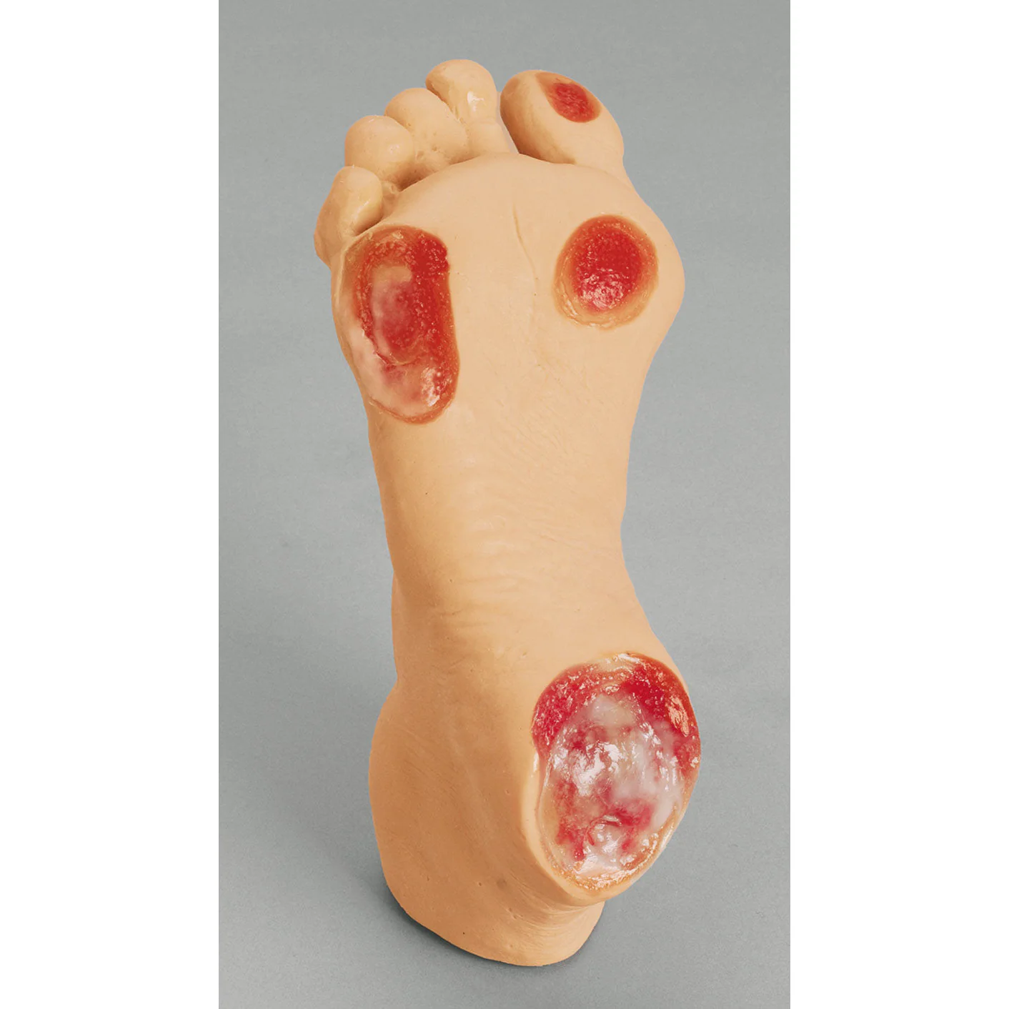 Elderly Pressure Ulcer Foot