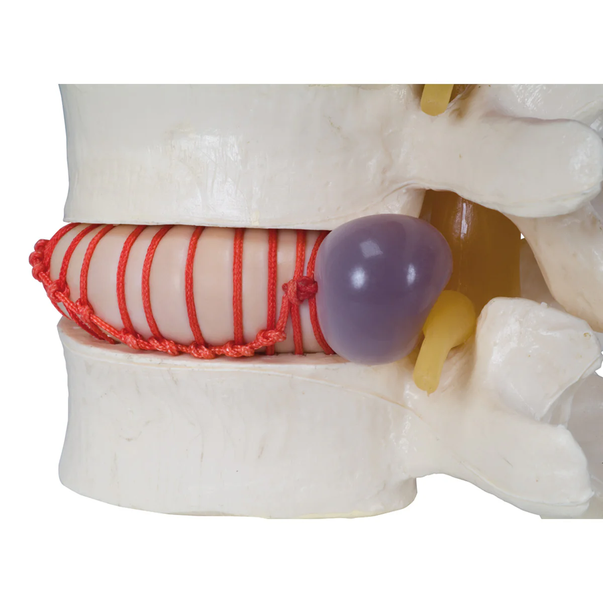 Herniated Disc Simulator - Image 3