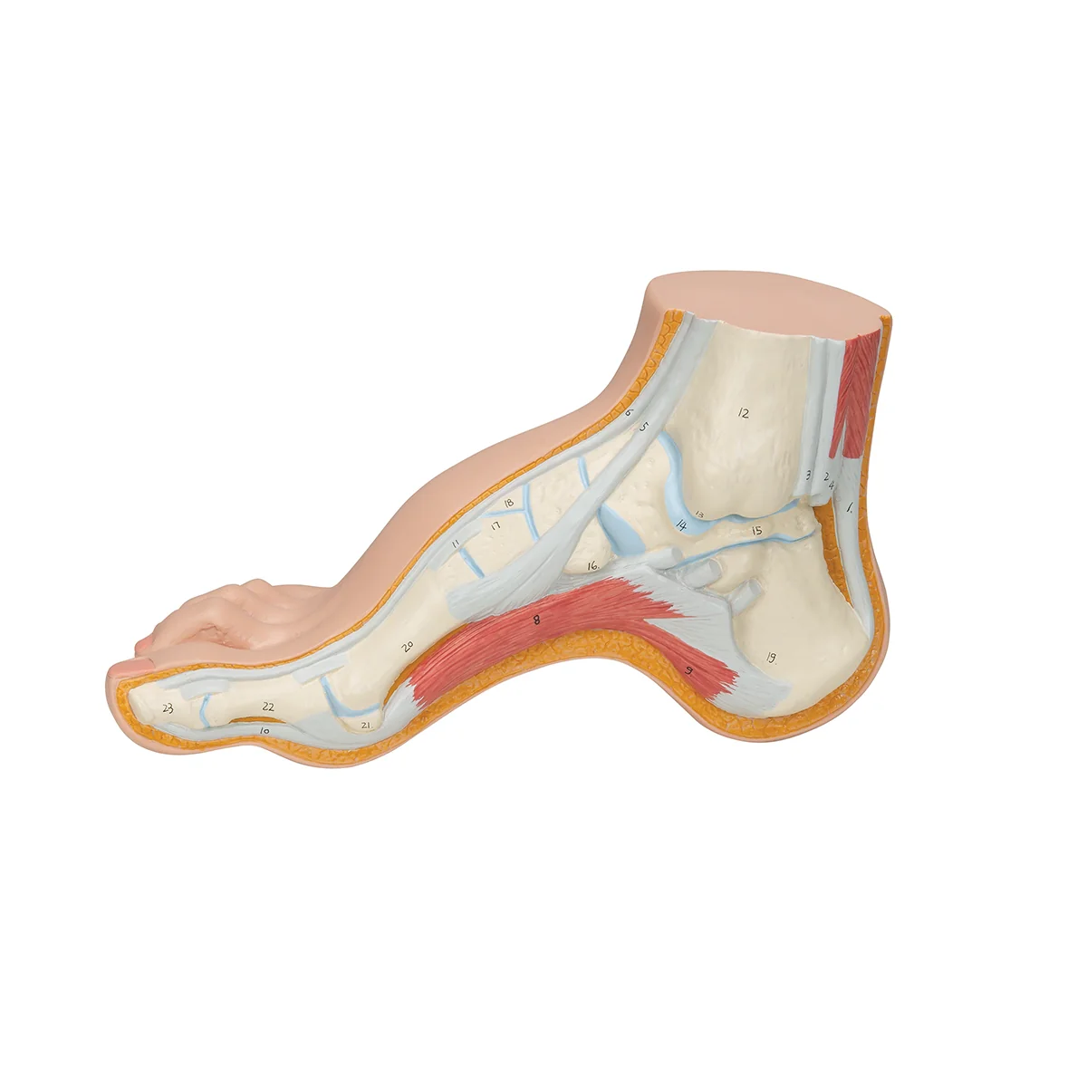 Hollow Foot (Pes Cavus) Model - Image 4