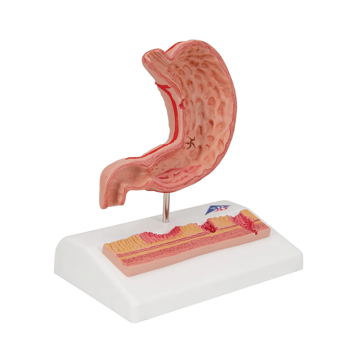 Human Stomach Section Model with Ulcers - Image 5