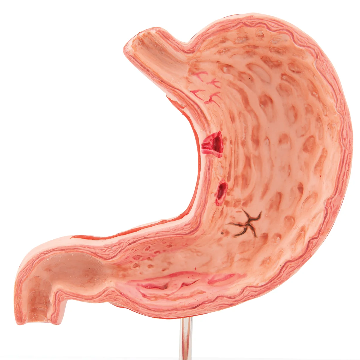 Human Stomach Section Model with Ulcers - Image 6