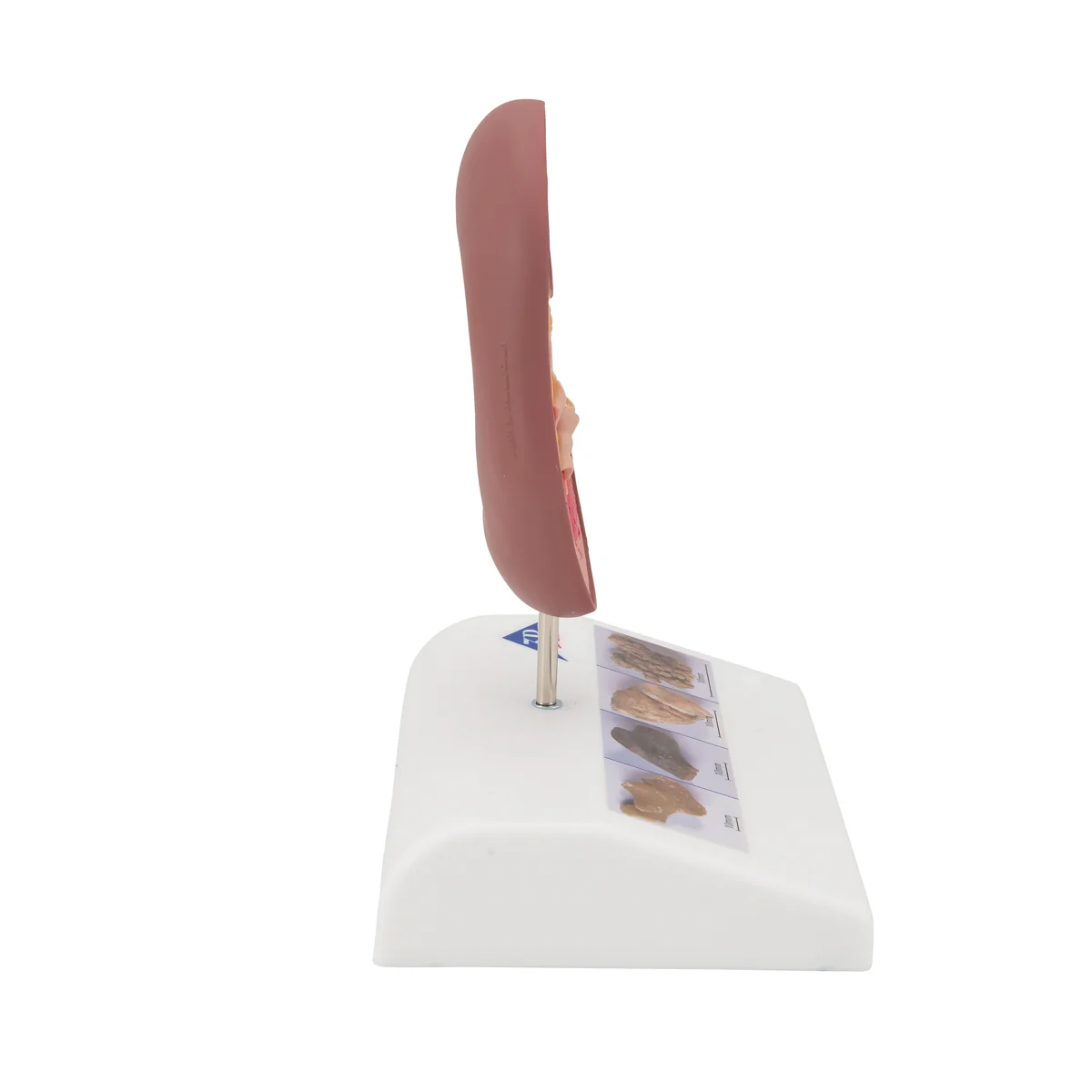 Kidney Stone Model - Image 2