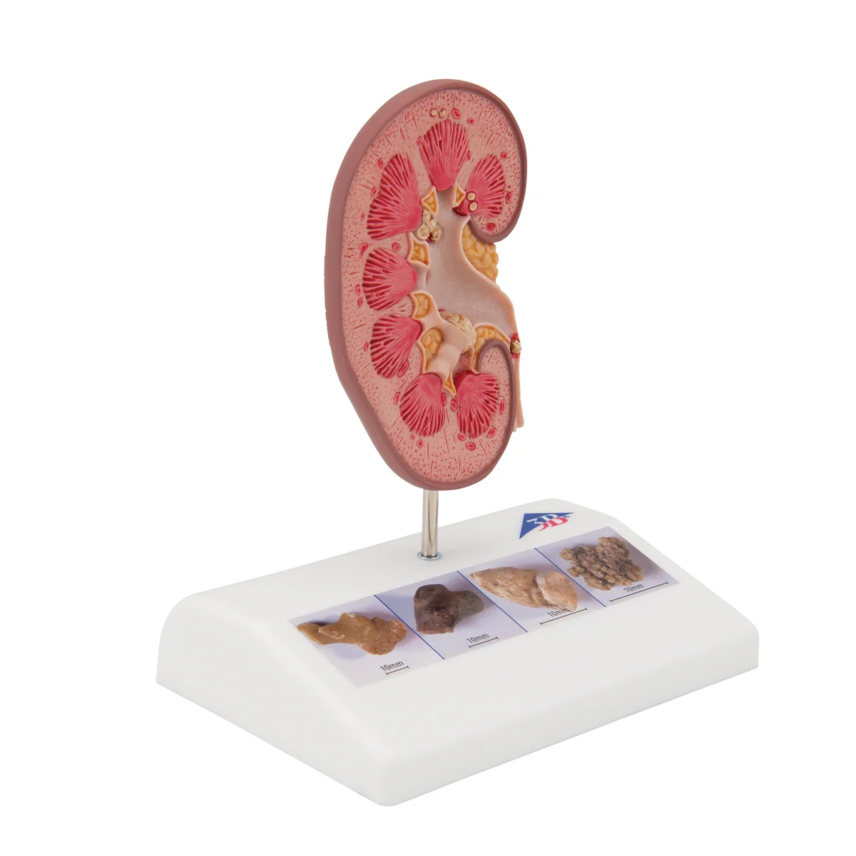 Kidney Stone Model - Image 3