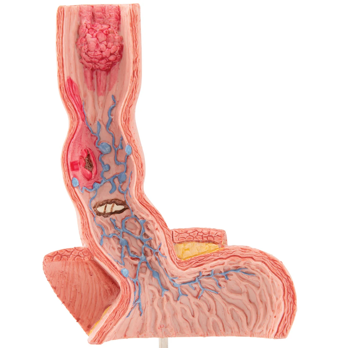 Life-Size Human Esophagus Diseases Model - Image 7