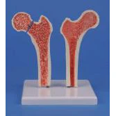 Osteoporosis Femur - Image 2