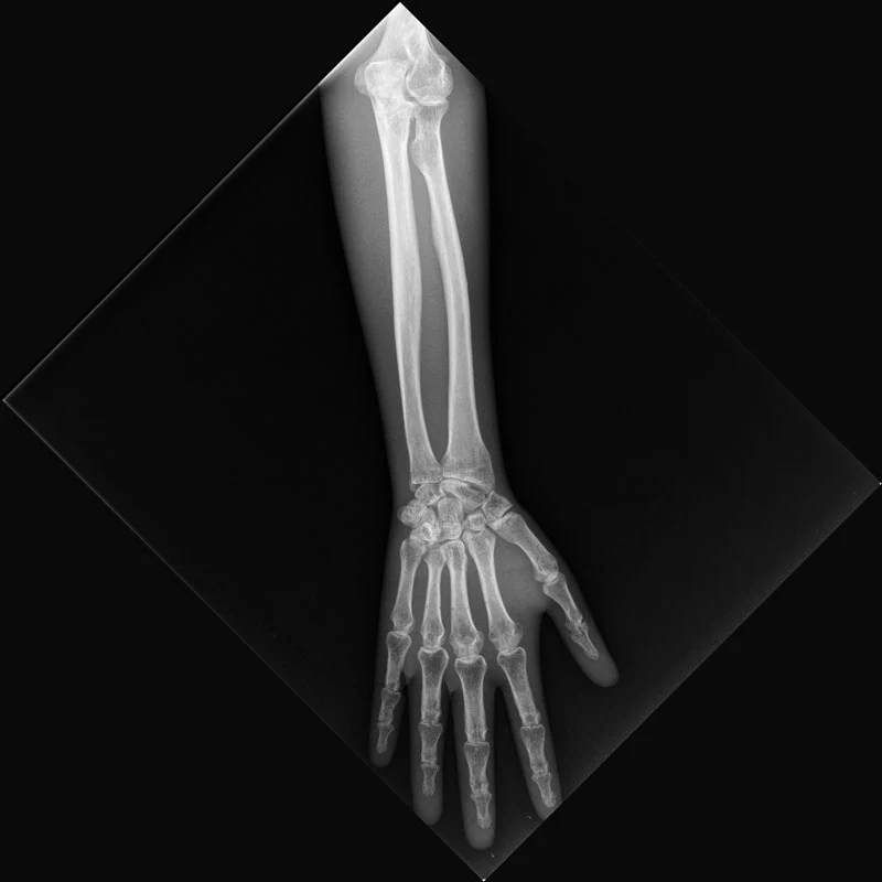 X-Ray Phantom Foot - Transparent